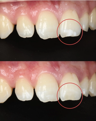 ICON® THERAPY – A SOLUTION FOR WHITE SPOTS, WITHOUT DRILLING OR TOOTH STRUCTURE LOSS